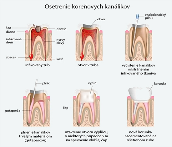 endodoncia